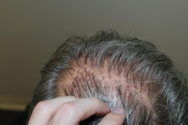 Hair Transplant Plugs | Past and Present of Hair Restoration