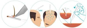 what is sapphire pen hair transplant