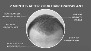 Two-Month Post-Transplant Phase