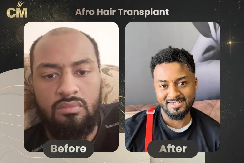 Before and after Afro hair transplant in Istanbul