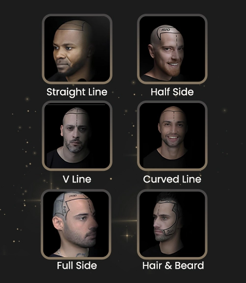All Sorts Of Hairlines Transplant