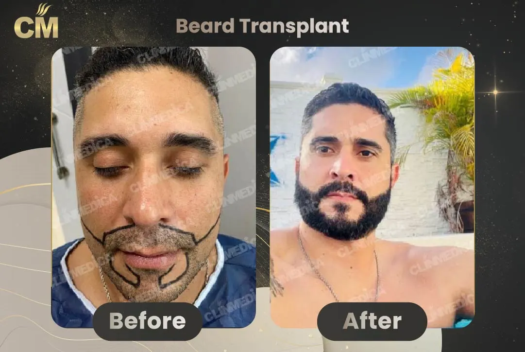 Beard Transplant Before and After in Turkey