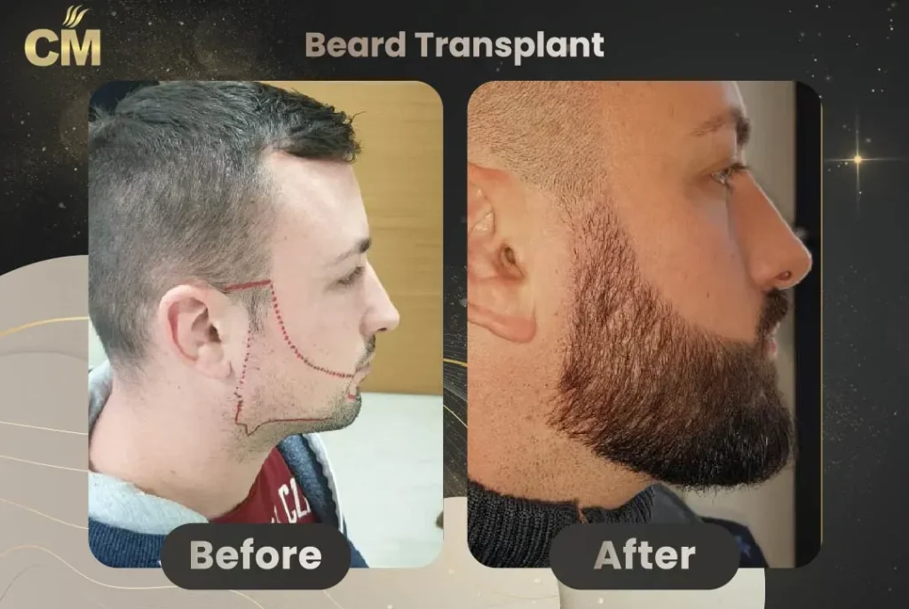 Beard Transplant Before and After in Turkey