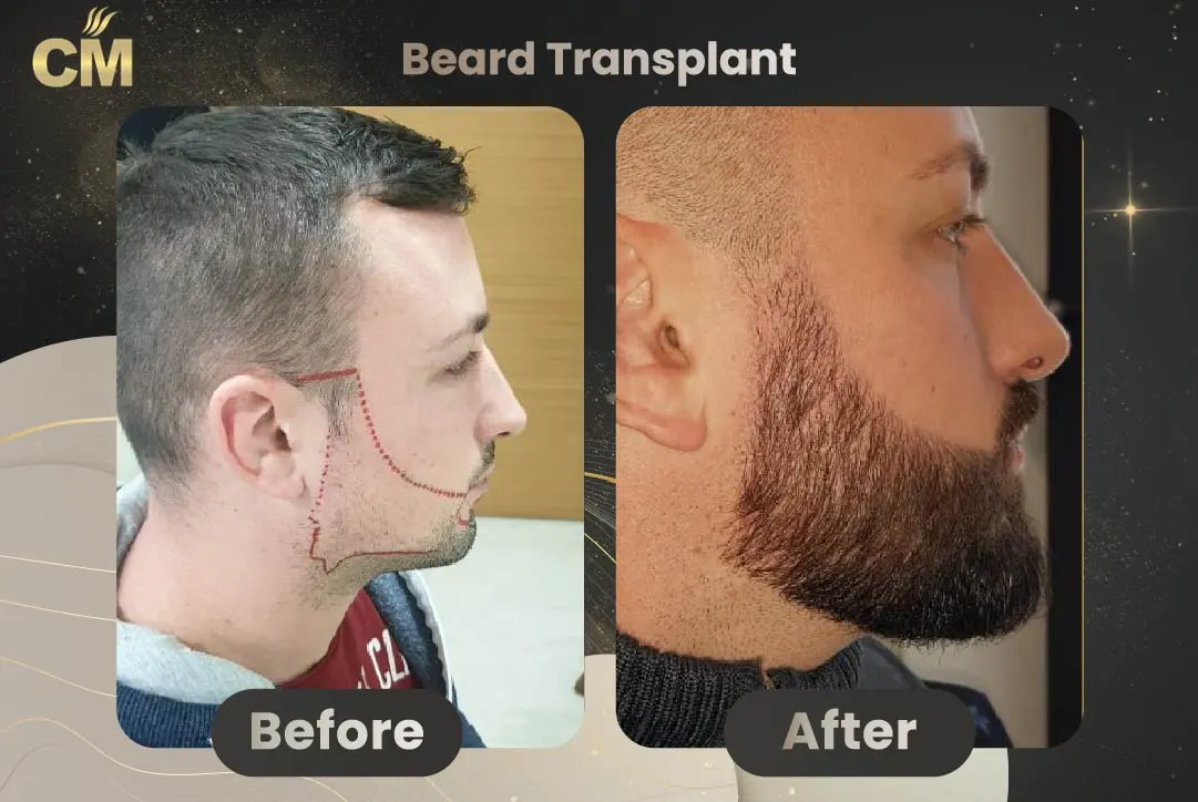 Beard Transplant Before and After in Turkey
