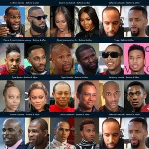 Celebrities with Hair Transplants