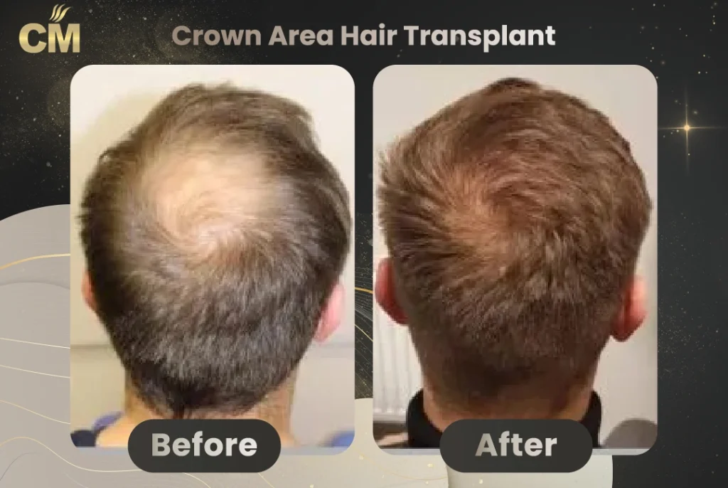 Crown Hair Transplant Before and After in Turkey