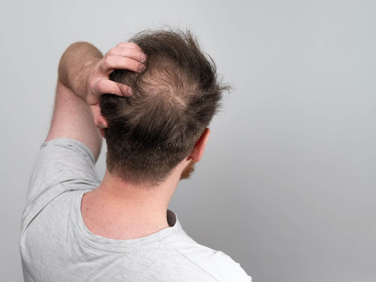 Crown Hair Transplant