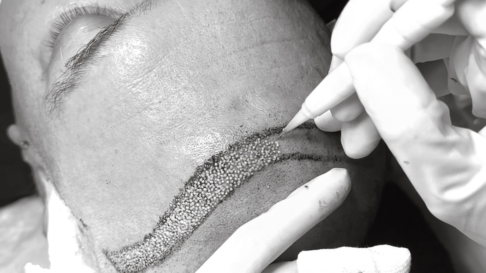 DHI-Hair-Transplant-choi-pens