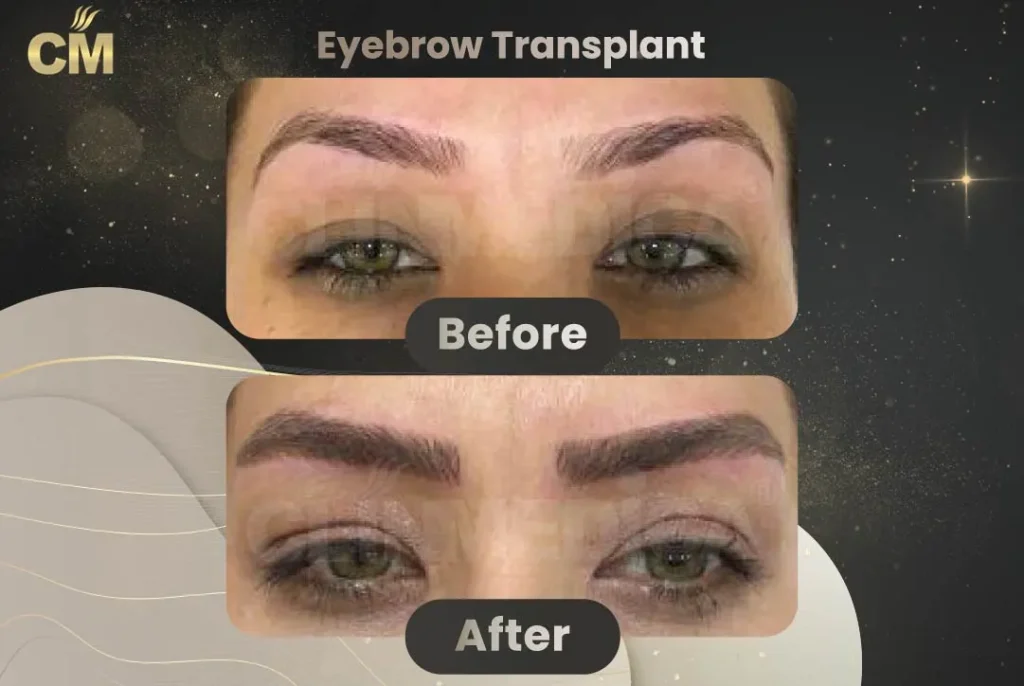 Eyebrow Transplant Before and After in Turkey