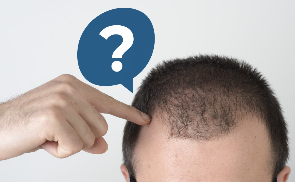 FAQs About Hair Transplant