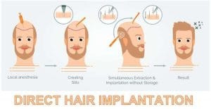 FUE-DHI Hair Transplant Techniques in Turkey