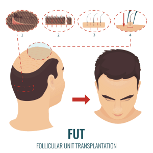 what is the procedure for hair transplant