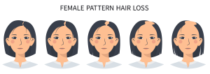 Female Pattern Baldness