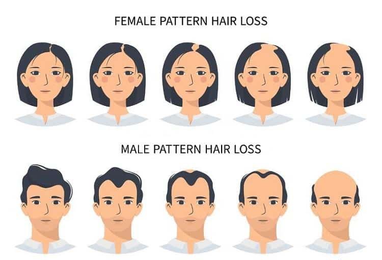 Genetic Baldness Affect Transplanted Hair