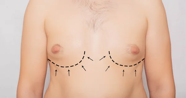 Gynecomastia Surgery Cost Worldwide and Turkey Prices