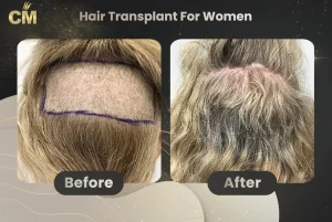 Hair Transplant For Women Before and After in Turkey