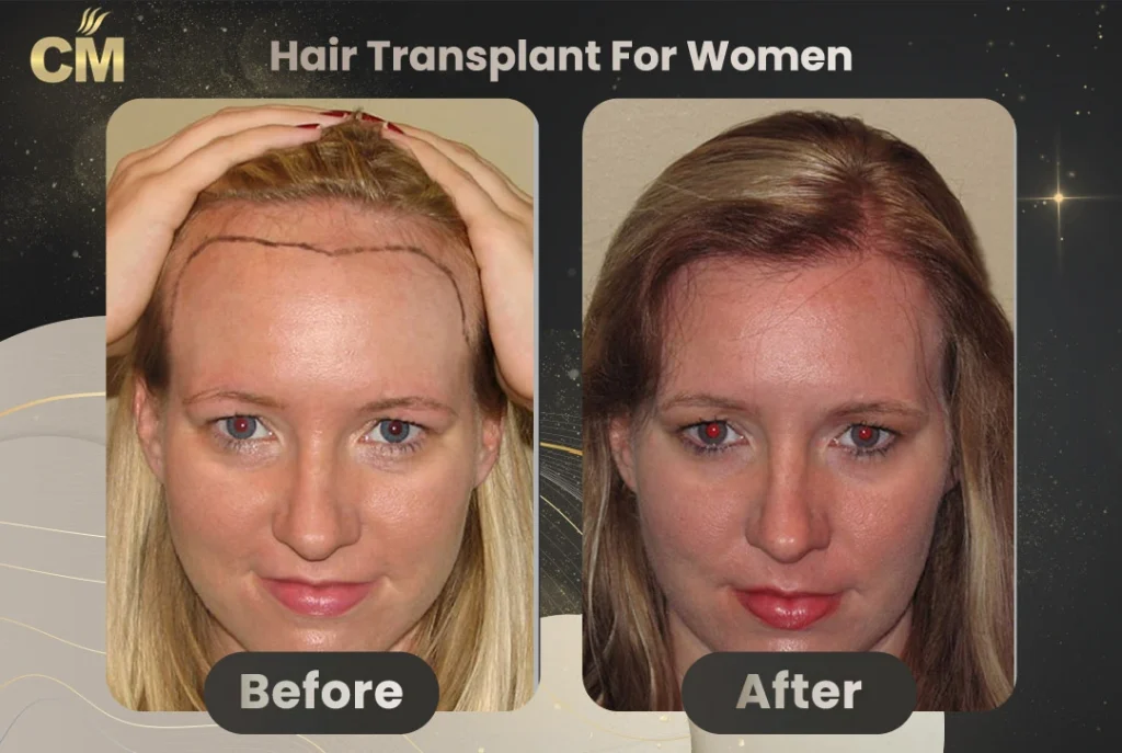 Hair Transplant For Women Before and After in Turkey