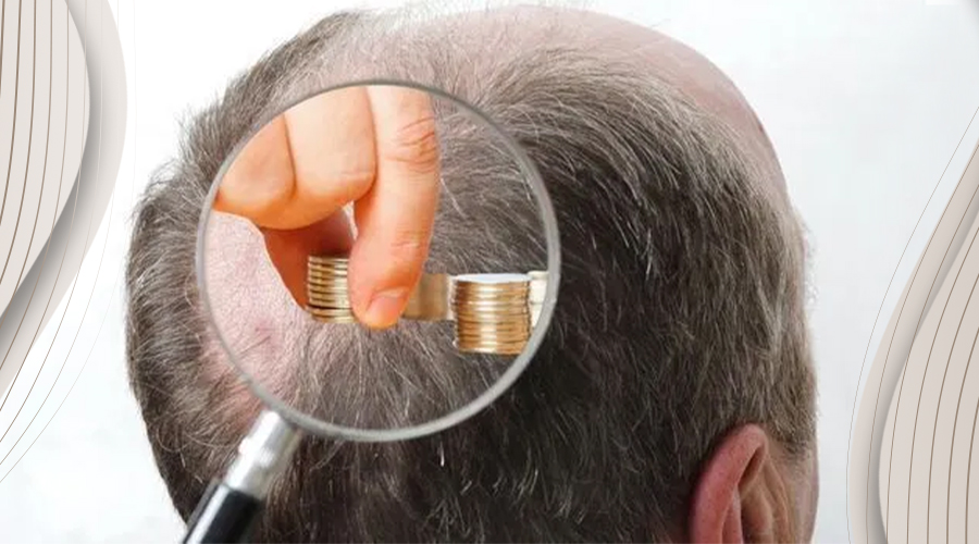 hair transplant cost in turkey