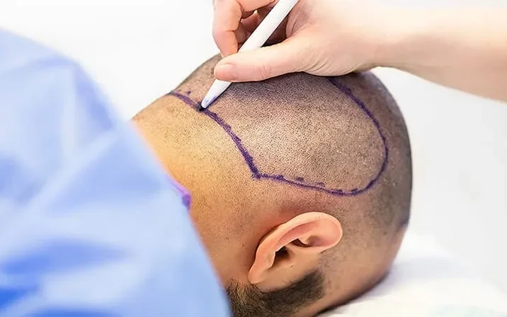 Hair Transplant Donor Area