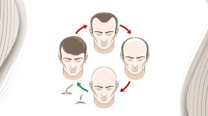 How Does a Hair Transplant Work?