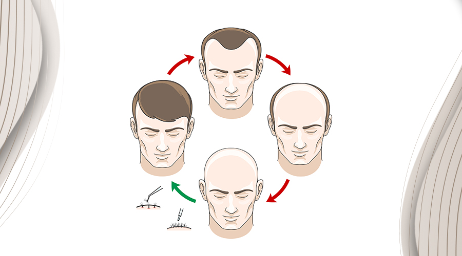 How Does a Hair Transplant Work?