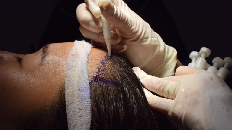 No Shave Hair Transplant