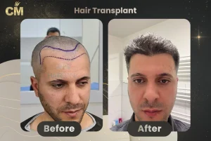 No shave hair transplant Before After