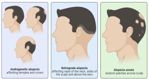 Signs of Alopecia Areata