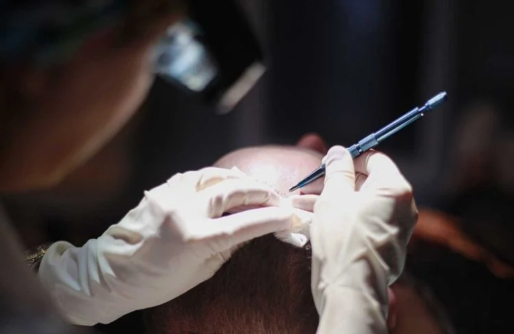 Sapphire FUE Hair Transplant