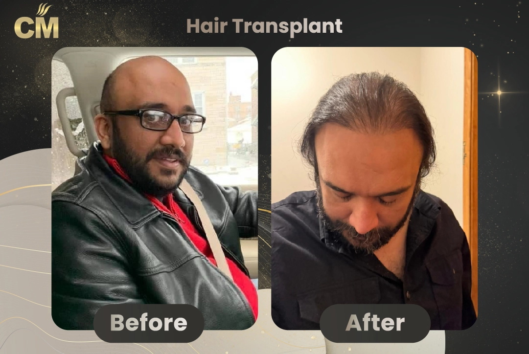 Sapphire-pen-hair-transplant-before-after-in-turkey