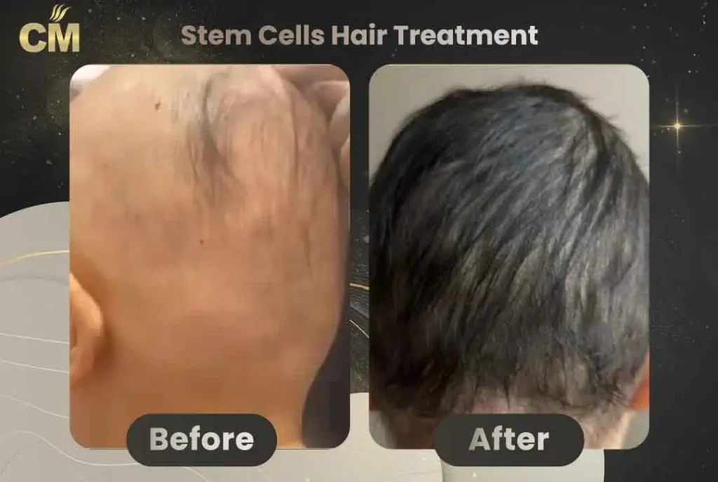 Stem Cells Hair Treatment Before and After in Turkey