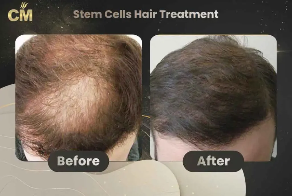 Stem Cells Hair Treatment Before and After in Turkey
