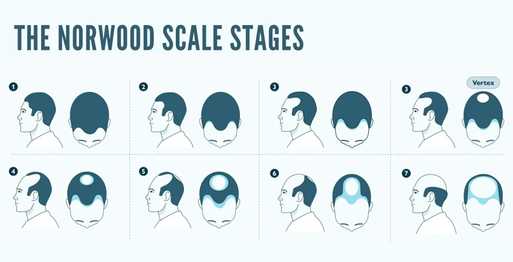 Understanding the Norwood Scale | A Comprehensive Guide