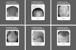 Two Months Post-Hair Transplant pictures