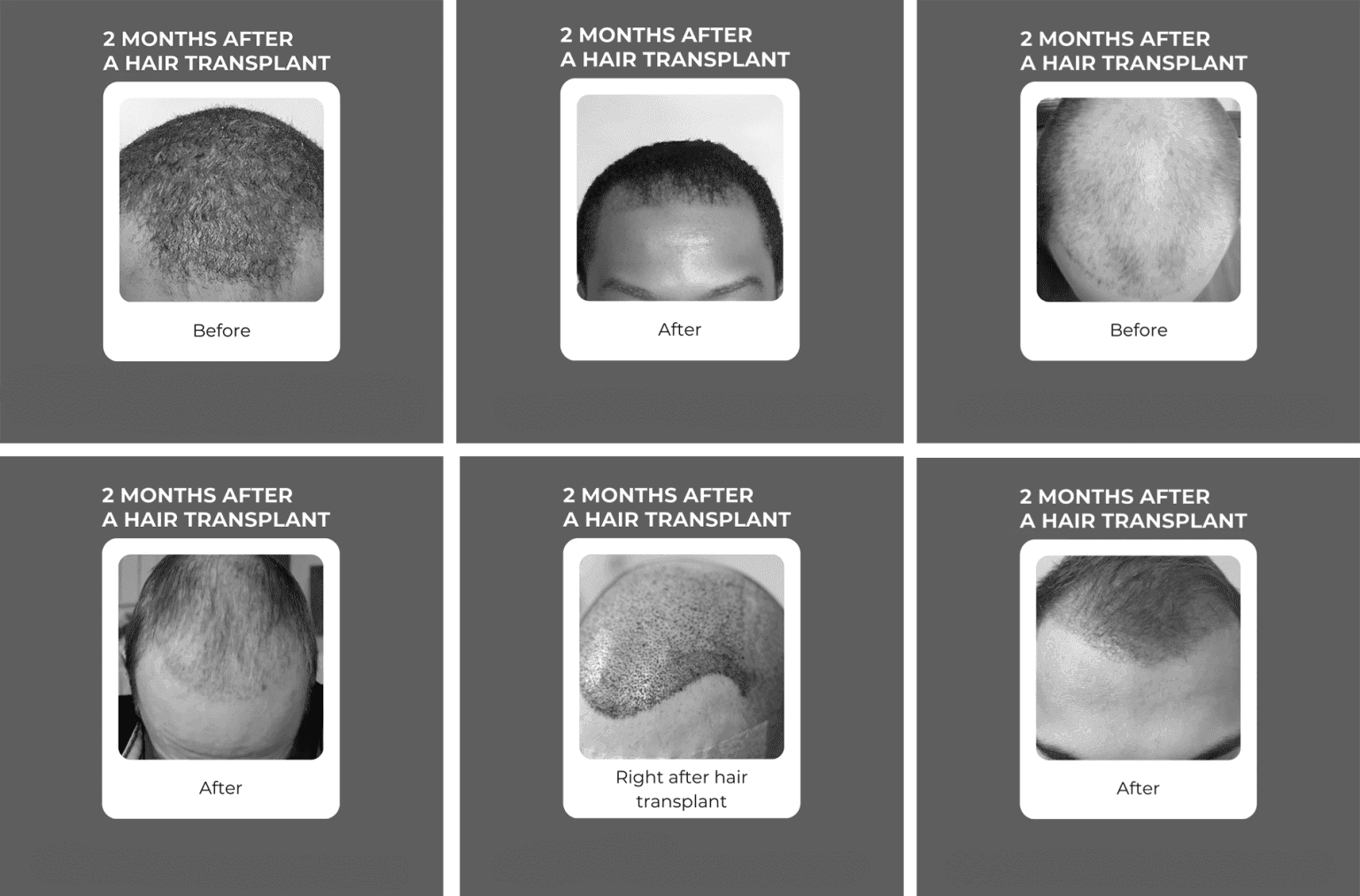 Collage of before, after, and immediate post-op images showing hair transplant progress at 2 months, highlighting different scalp areas and hair types.