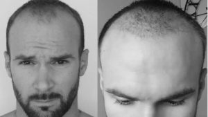 What to Expect Two Months After Your Hair Transplant