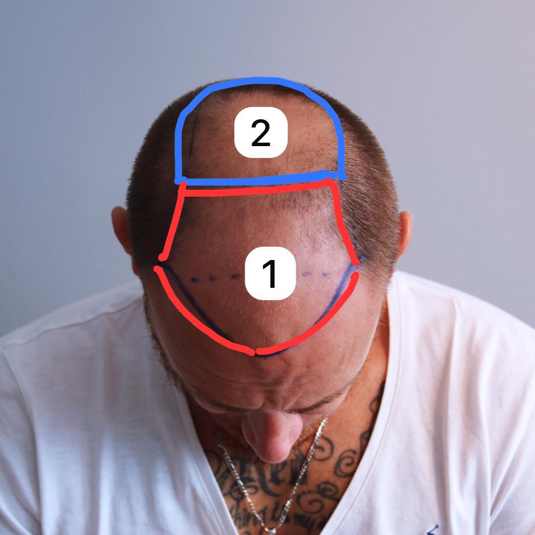 Why Hair Transplantation in Two Sessions?