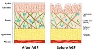 AGF-39 Hair Loss Treatment In Turkey