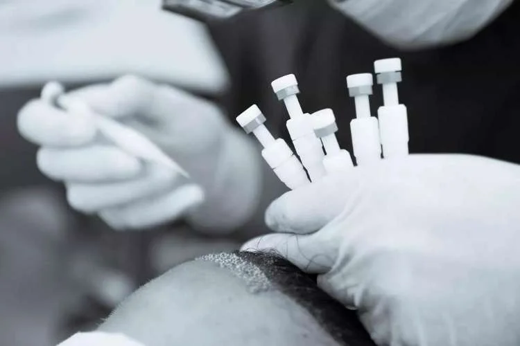 DHI Hair Transplant