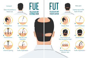 fue vs fut hair transplant