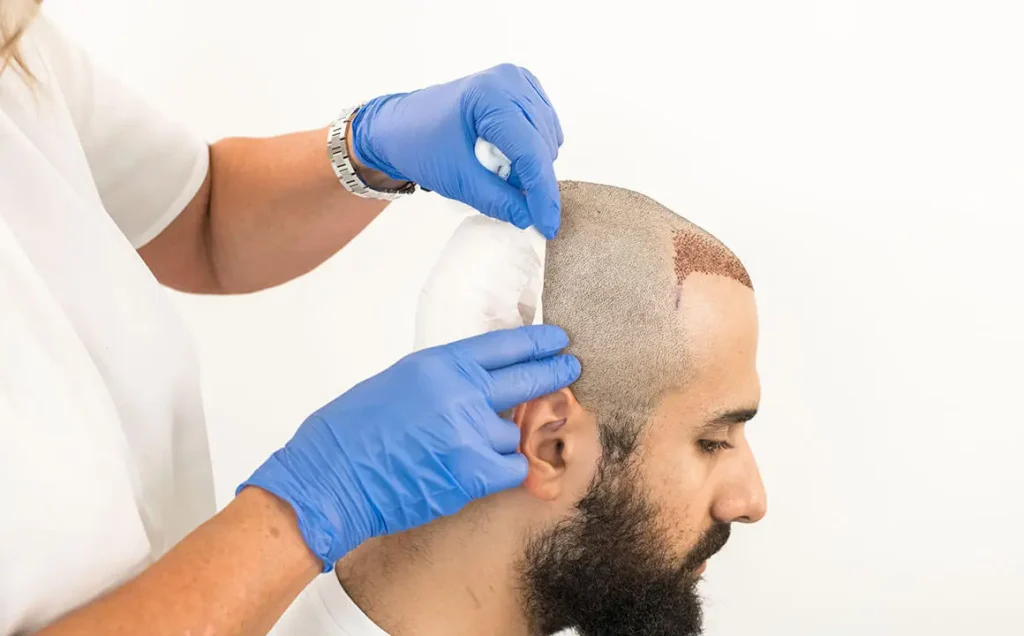 Pre And Post Hair Transplant