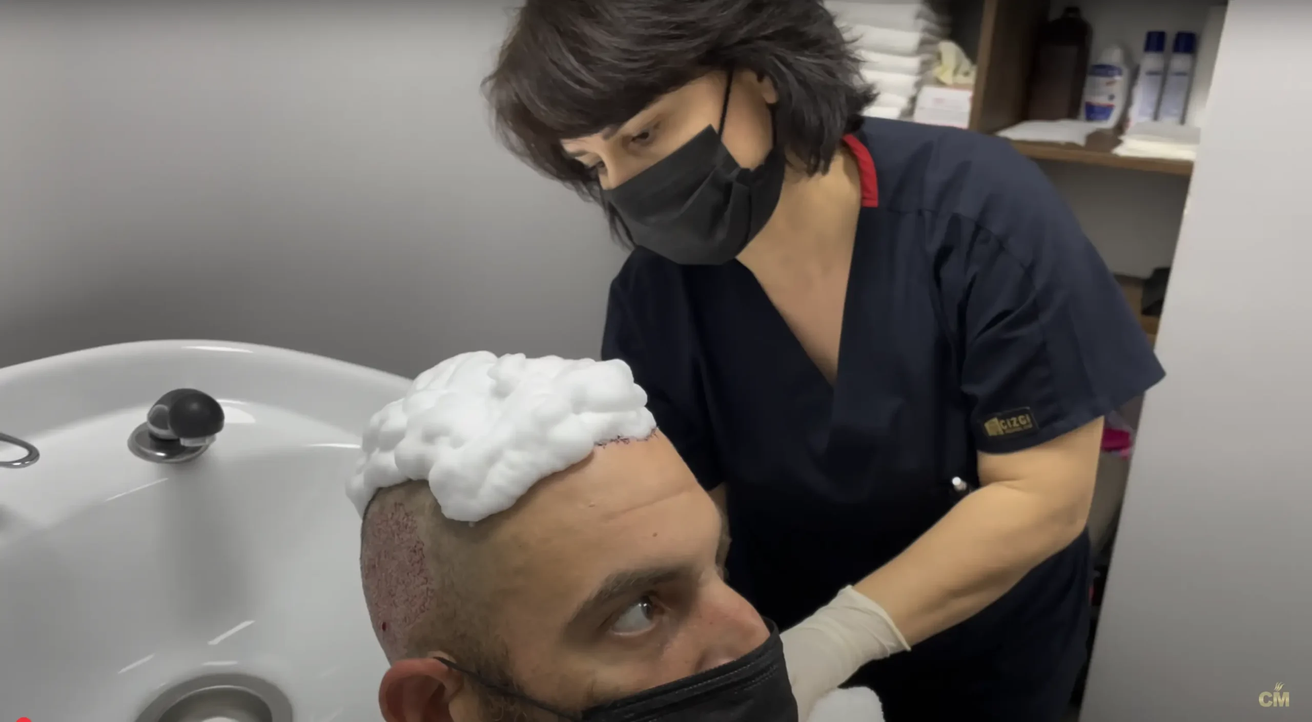 How wash hair after hair transplantation