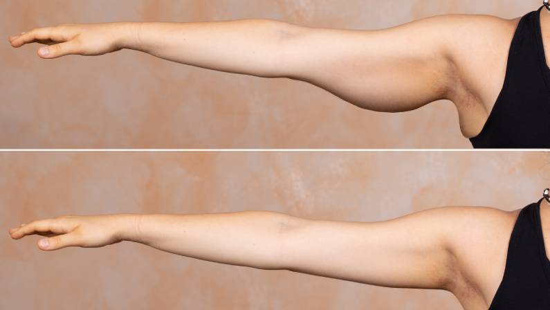 Arm Lift surgery
