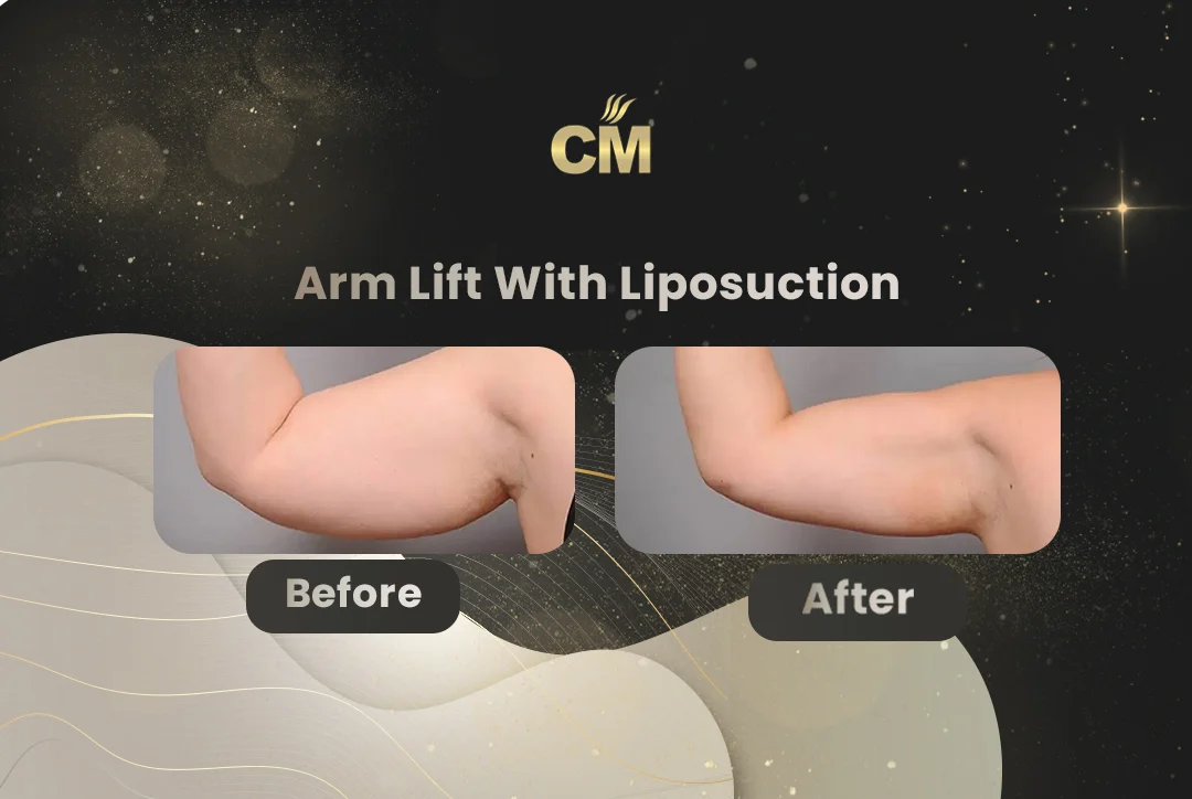 Arm Lift Before After-18