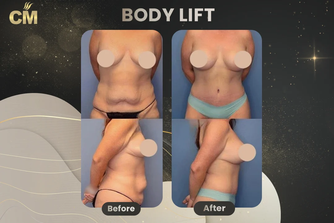 Back Lift (Bra Line Back Lift) Before After-3