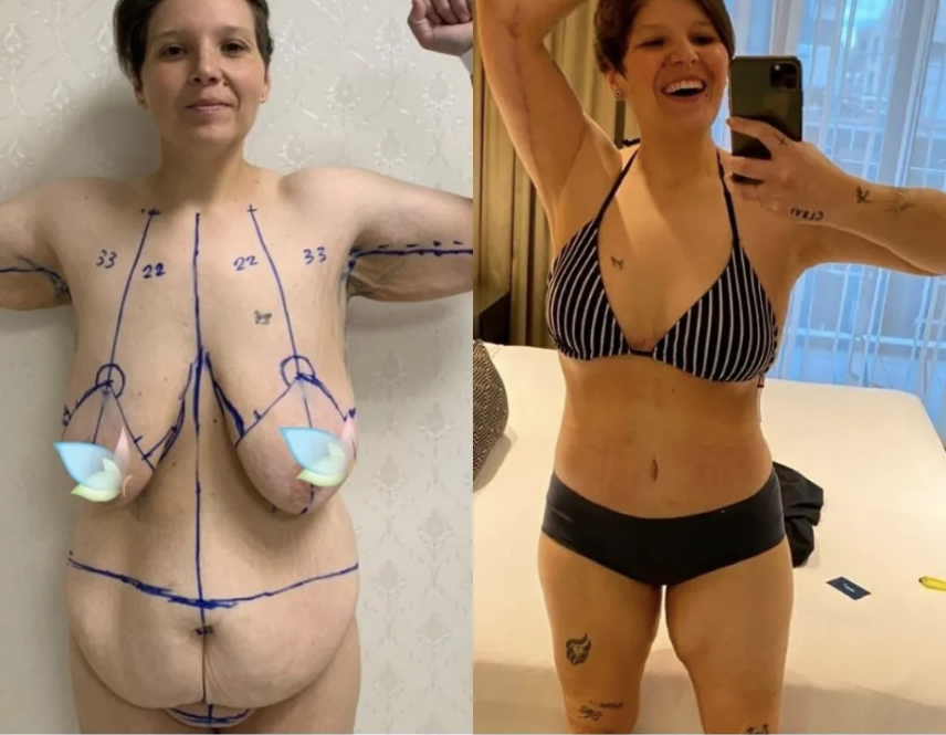 Body Lift: Skin Removal Surgery Before and After
