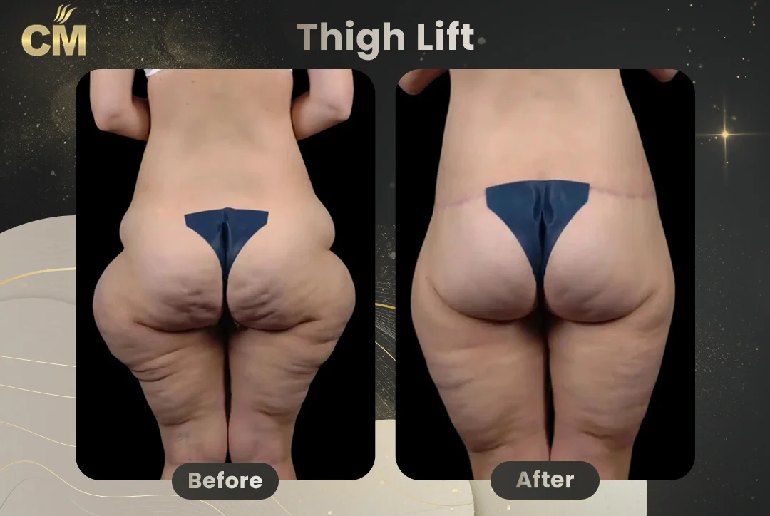 Thigh Lift Before After-11