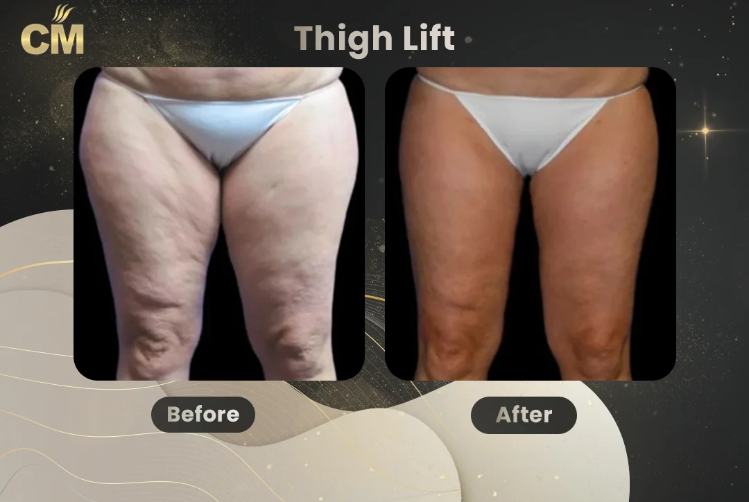 Thigh Lift Before After-3