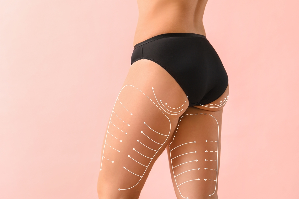 Thigh-Lift-surgery