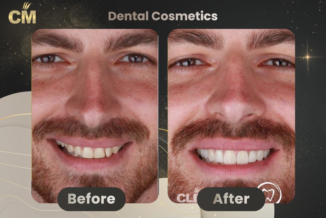 Hollywood Smile Before and After in Turkey men